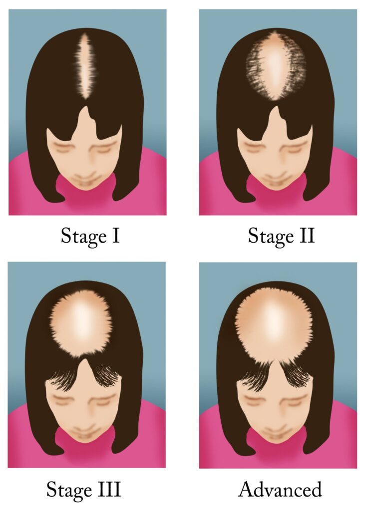hair loss shampoos