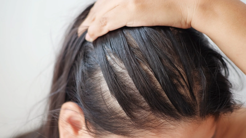 Hair loss shampoo