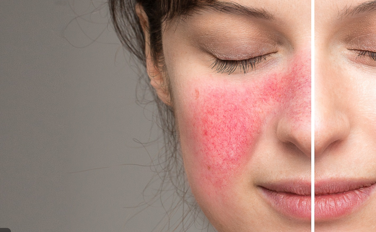 skincare ingredients to avoid for rosacea